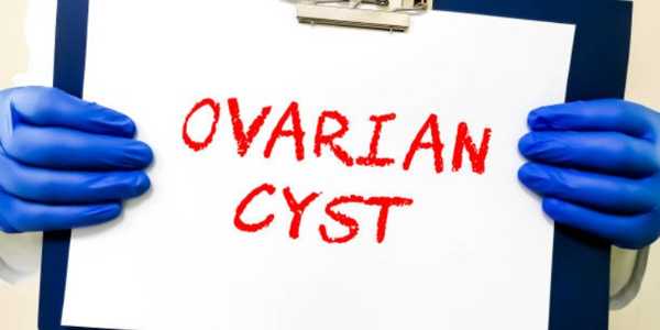 What Every Woman Should Know About Ovarian Cysts