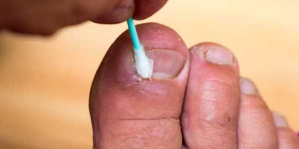 How To Treat Minor Fungal Infections Naturally