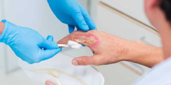 Natural Treatments for Minor Burns: Home Remedies & Tips